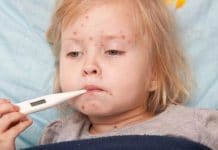 Ospice (morbilli) – uzroci, simptomi i liječenje Ospice (morbilli) – uzroci, simptomi i liječenje