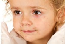 Rubeola – uzroci, simptomi i liječenje Rubeola – uzroci, simptomi i liječenje