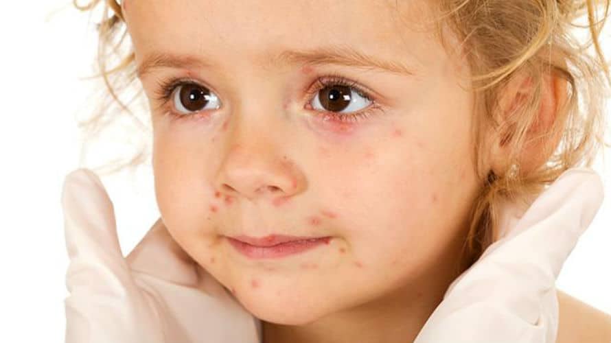 Rubeola – uzroci, simptomi i liječenje Rubeola – uzroci, simptomi i liječenje