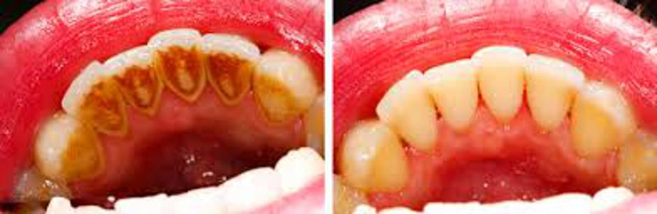Zubni kamenac - prije i poslije