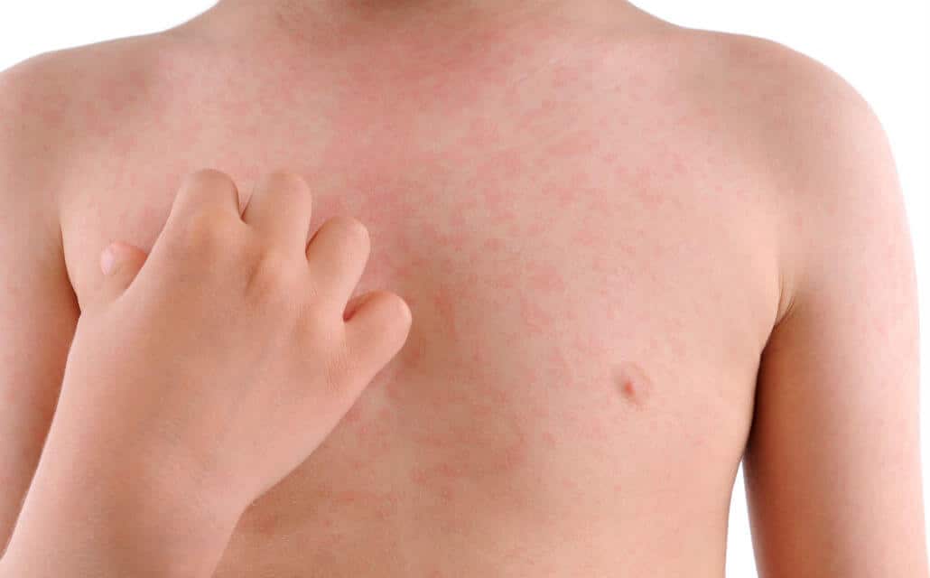 alergije i bolovi u zglobovima kod djece)