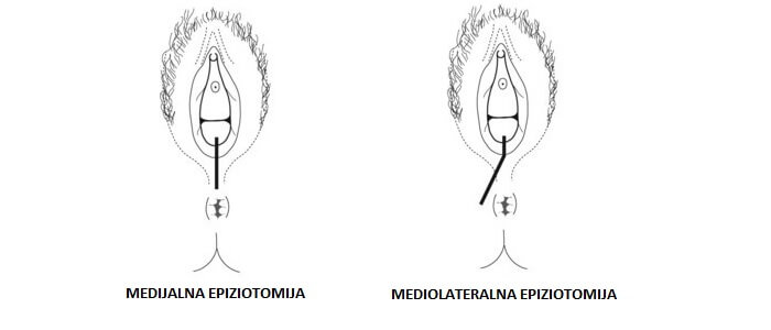 Epiziotomija pri porodu