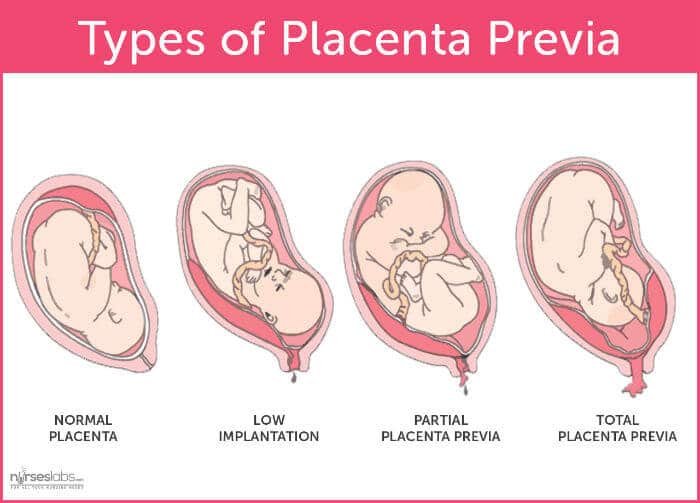 Placenta previa