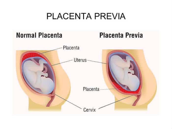 Placenta previa