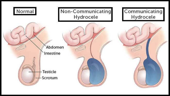 Hidrokela