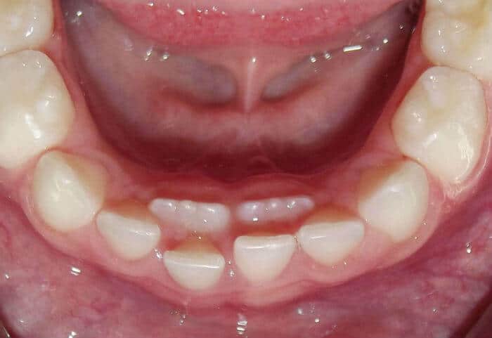 Mliječni zubi