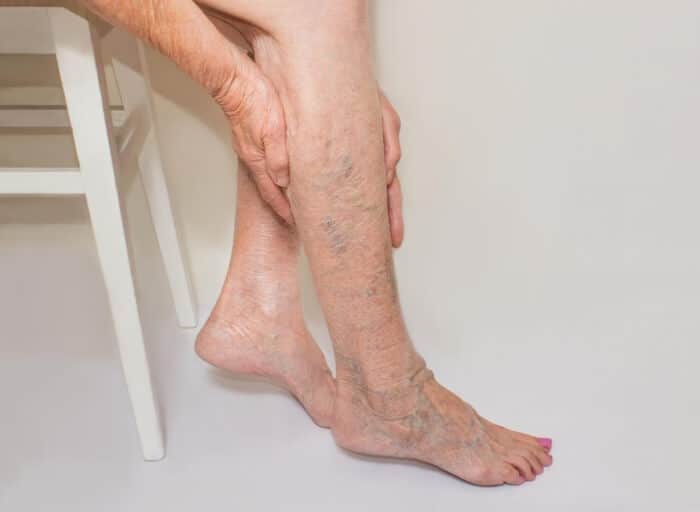 Bolovi u nogama u mirovanju: Uzrok, simptomi i kada se morate javiti doktoru? - N1