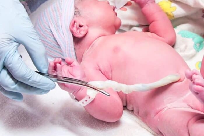 Pupak kod beba - njega pupka u prvim danima života