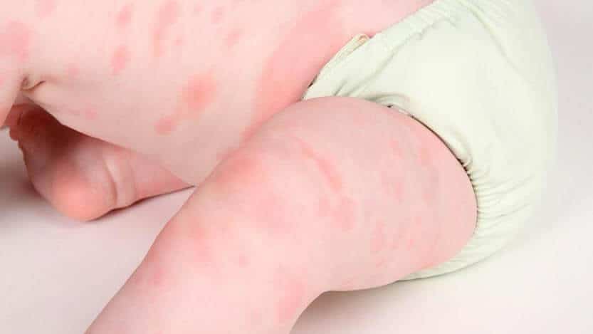 Osip kao posljedica alergijske reakcije kod djece