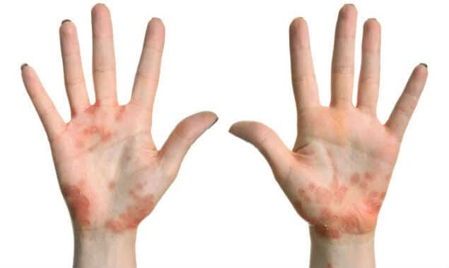 Prikaz alergijskog ekcema na rukama