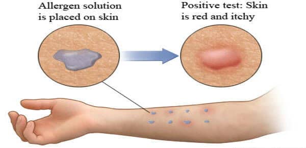 Kožno testiranje na alergije