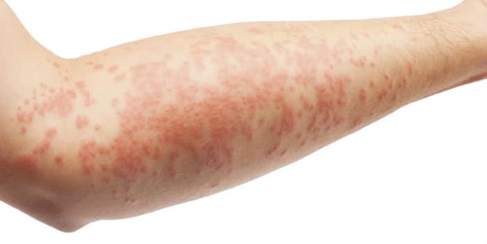 Atopijski dermatitis na ruci odrasle osobe