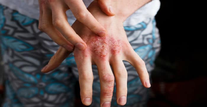 Atopijski dermatitis na ruci odrasle osobe