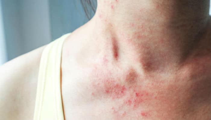 Atopijski dermatitis na vratu odrasle osobe