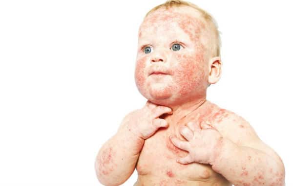 Atopijski dermatitis na licu i tijelu bebe