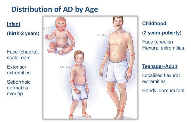 Atopijski dermatitis kod beba, djece i odraslih - mjesto pojavljivanja