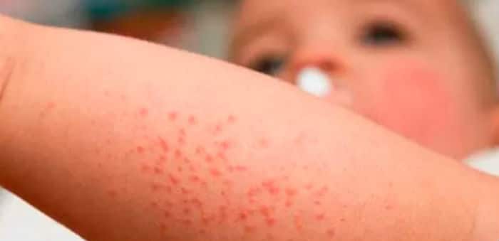Atopijski dermatitis na nozi djeteta