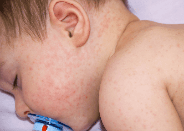 Atopijski dermatitis na licu i trupu bebe