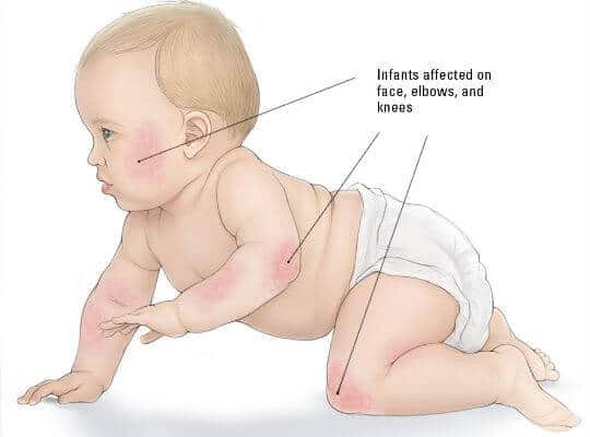 Atopijski dermatitis - simptomi, uzroci i liječenje