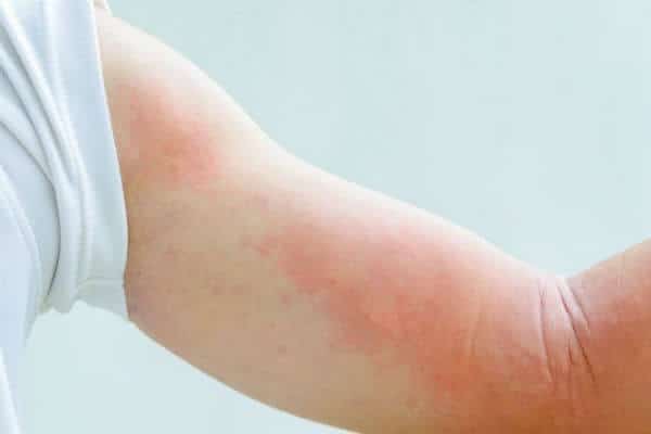 Atopijski dermatitis - simptomi, uzroci i liječenje