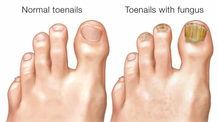 Prikaz zdravih noktiju na nogama i noktiju zaraženih gljivicama