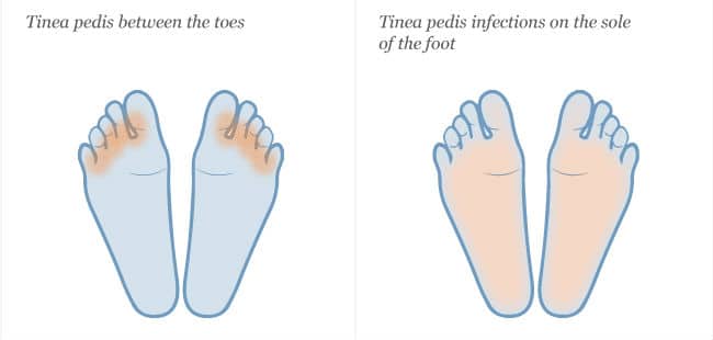 Tinea pedis između prstiju i na stopalima