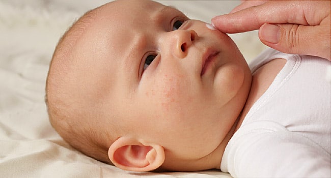 Atopijski dermatitis na licu bebe