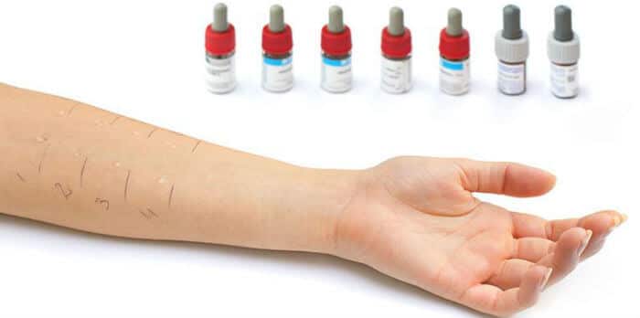 Skin prick test za alergiju