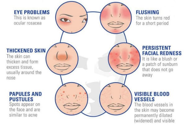 Розацея это такое схема лечения симптомы. Розацея это такое у женщин схема. Розацея это такое у мужчин схема лечения симптомы. Розацея это такое у женщин схема лечения.
