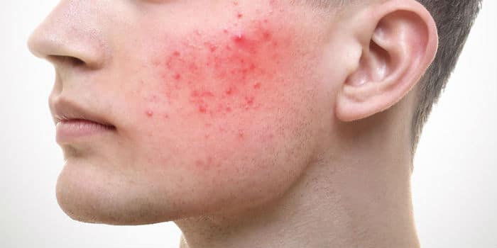 Rosacea (rozacea) - zašto nastaje i kako se liječi?