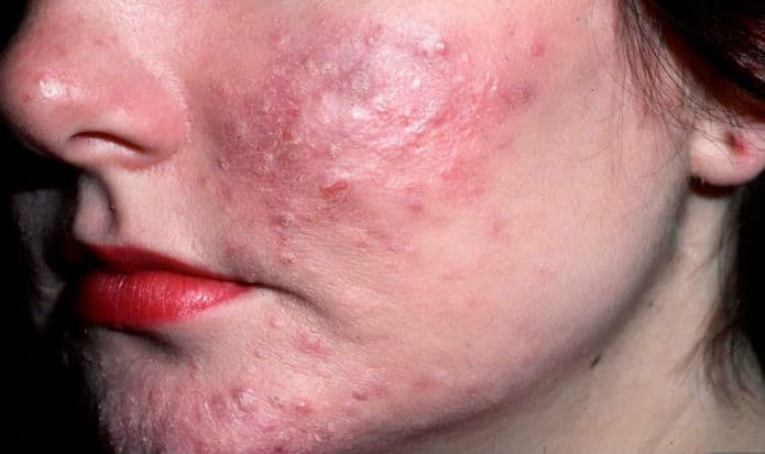 Rosacea (rozacea) - zašto nastaje i kako se liječi?