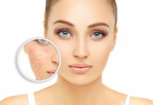 Rosacea (rozaceja) – zašto nastaje i kako se liječi? Rosacea (rozacea) - zašto nastaje i kako se liječi?