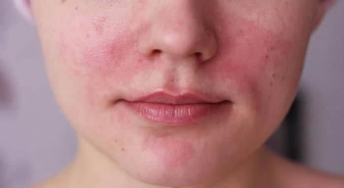 Rosacea (rozacea) - zašto nastaje i kako se liječi?