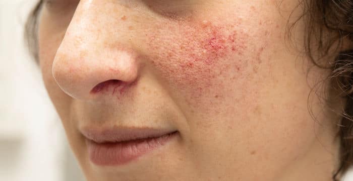 Rosacea (rozacea) - zašto nastaje i kako se liječi?