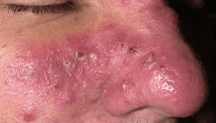 Rosacea (rozacea) - zašto nastaje i kako se liječi?