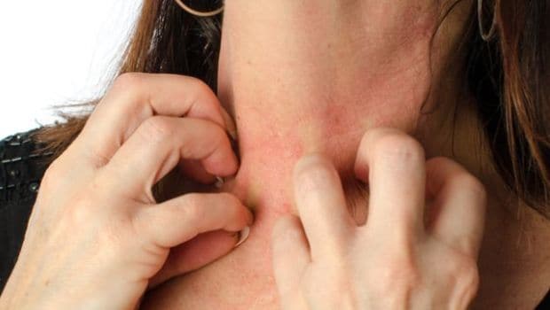 Rosacea (rozacea) - zašto nastaje i kako se liječi?