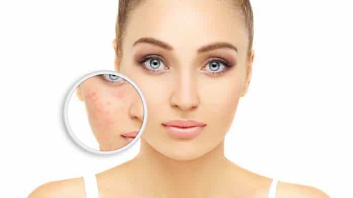 Rosacea (rozacea) - zašto nastaje i kako se liječi?