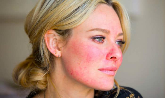 Rosacea (rozacea) - zašto nastaje i kako se liječi?