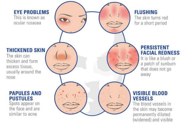 Simptomi rosacee