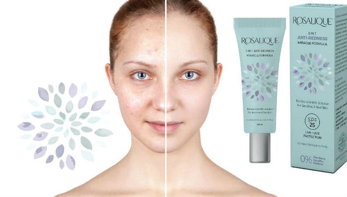 Rosacea (rozaceja) - zašto nastaje i kako se liječi?