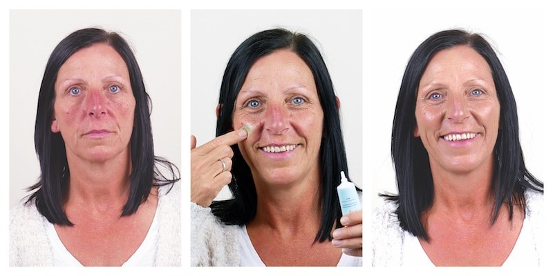Rosalique krema - fotografije korisnika prije i nakon korištenja